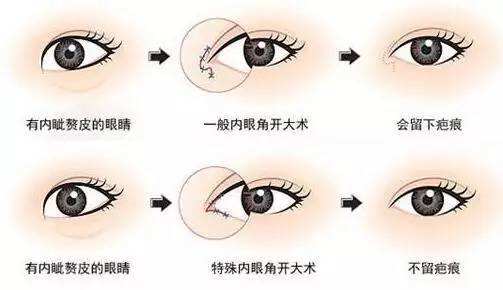 杭州雙眼皮修復(fù)知名專家排行榜 杭州最好的雙眼皮修復(fù)專家排名 杭州最好的雙眼皮修復(fù)專家有哪些?
