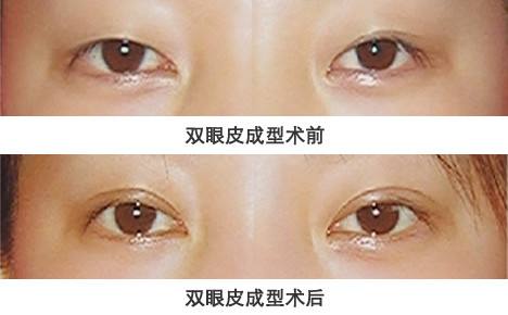鄭州雙眼皮修復權威專家排行榜 鄭州雙眼皮修復最好的專家排名 鄭州雙眼皮修復最好的專家有哪些？