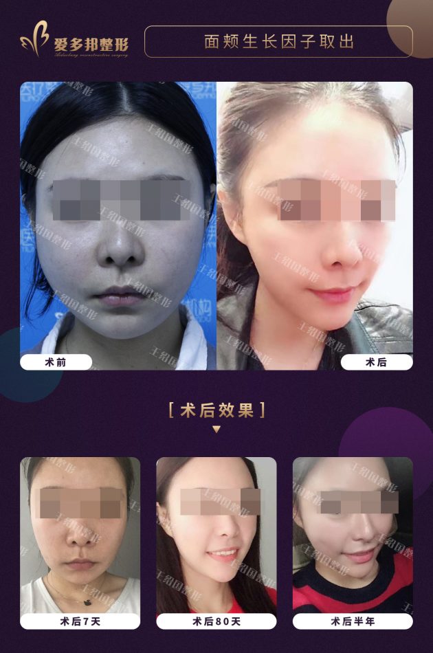 王紹國取生長因子
