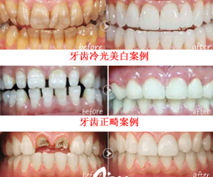 牙齒案例
