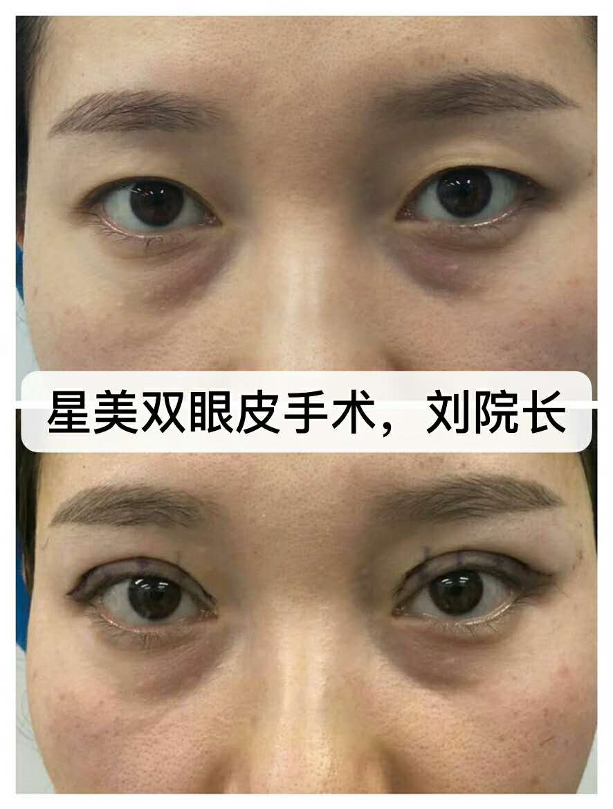 劉勇案例