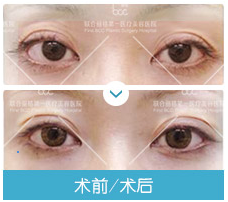 眼修復