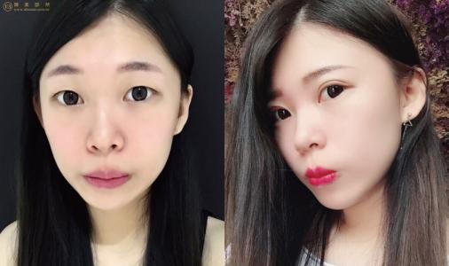 鄭州做雙眼皮的專家有哪些?哪個醫(yī)生性價比高?