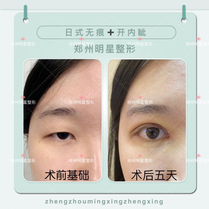 日式無痕雙眼皮案例