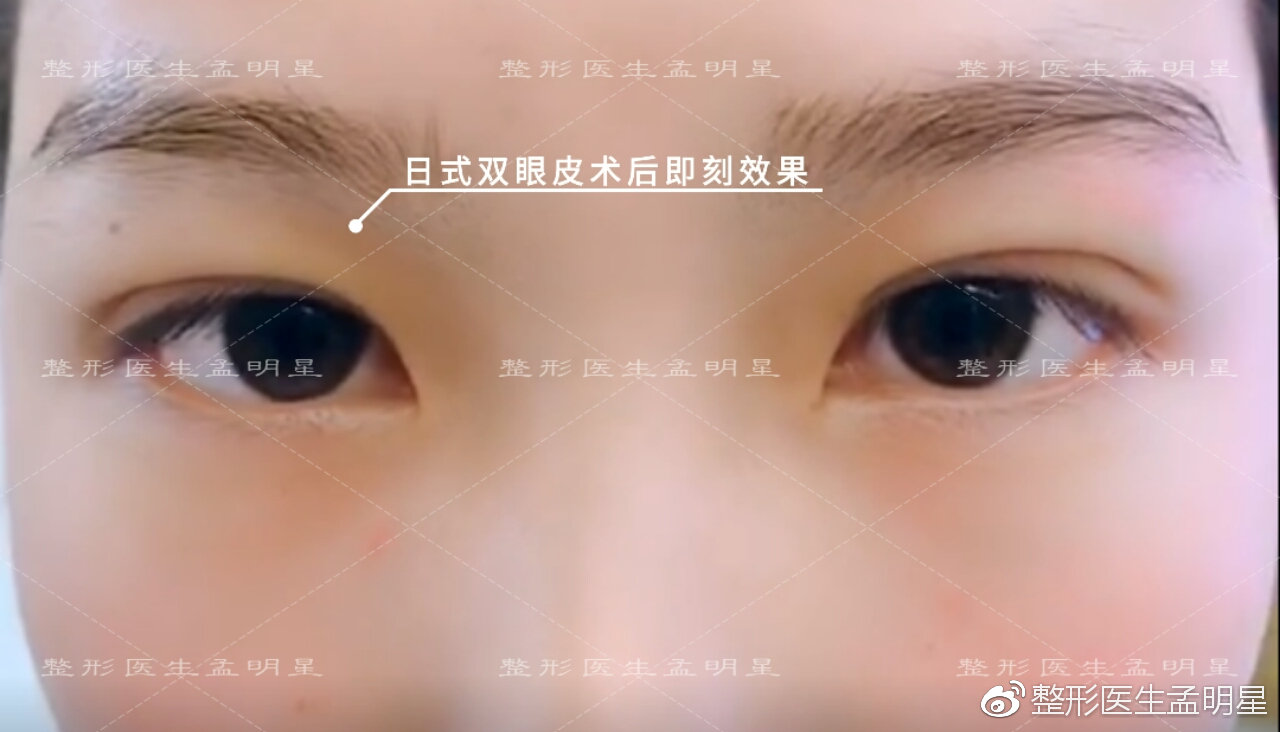 日式無痕雙眼皮案例