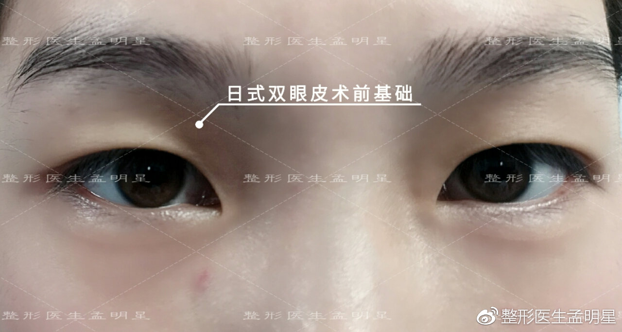 日式無痕雙眼皮案例