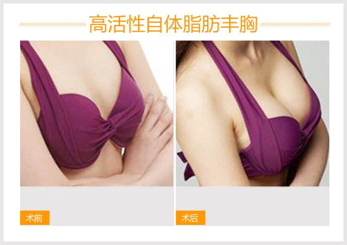王沛森脂肪豐胸