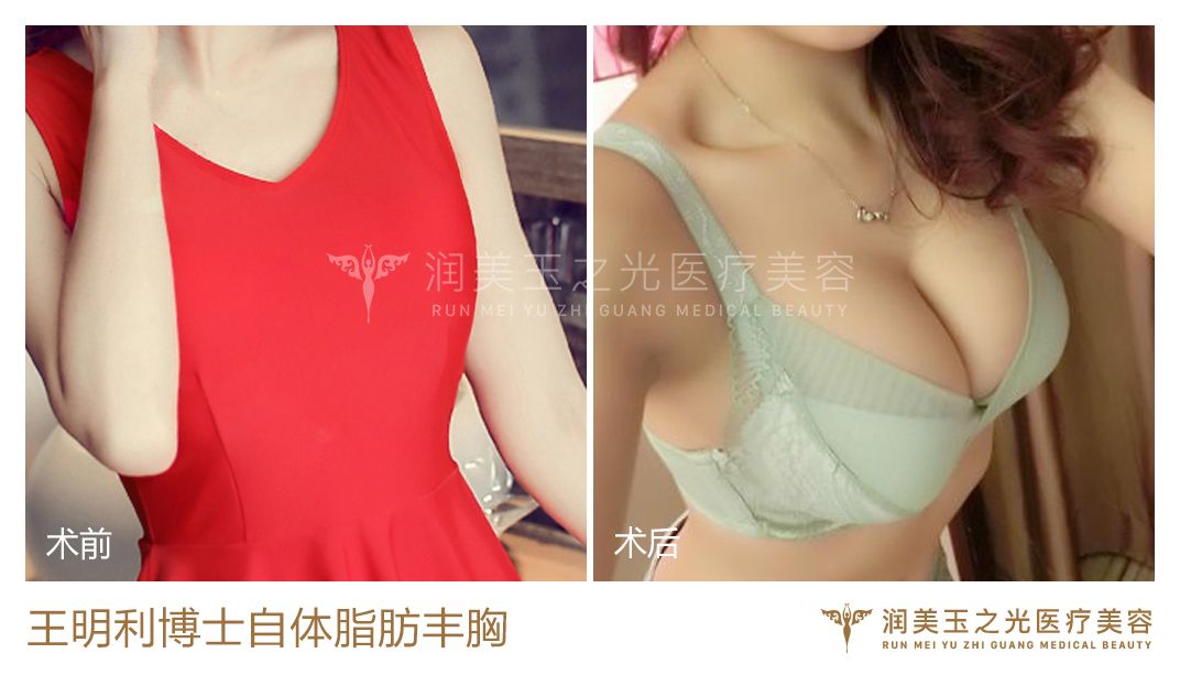 王明利脂肪豐胸