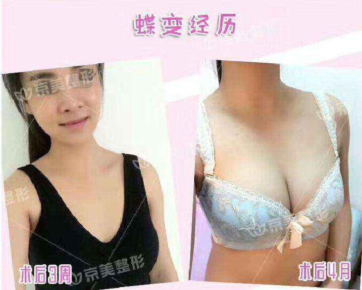 劉成勝脂肪豐胸