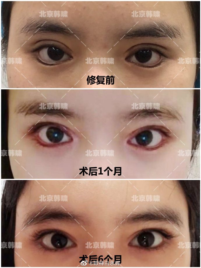 白永輝雙眼皮修復