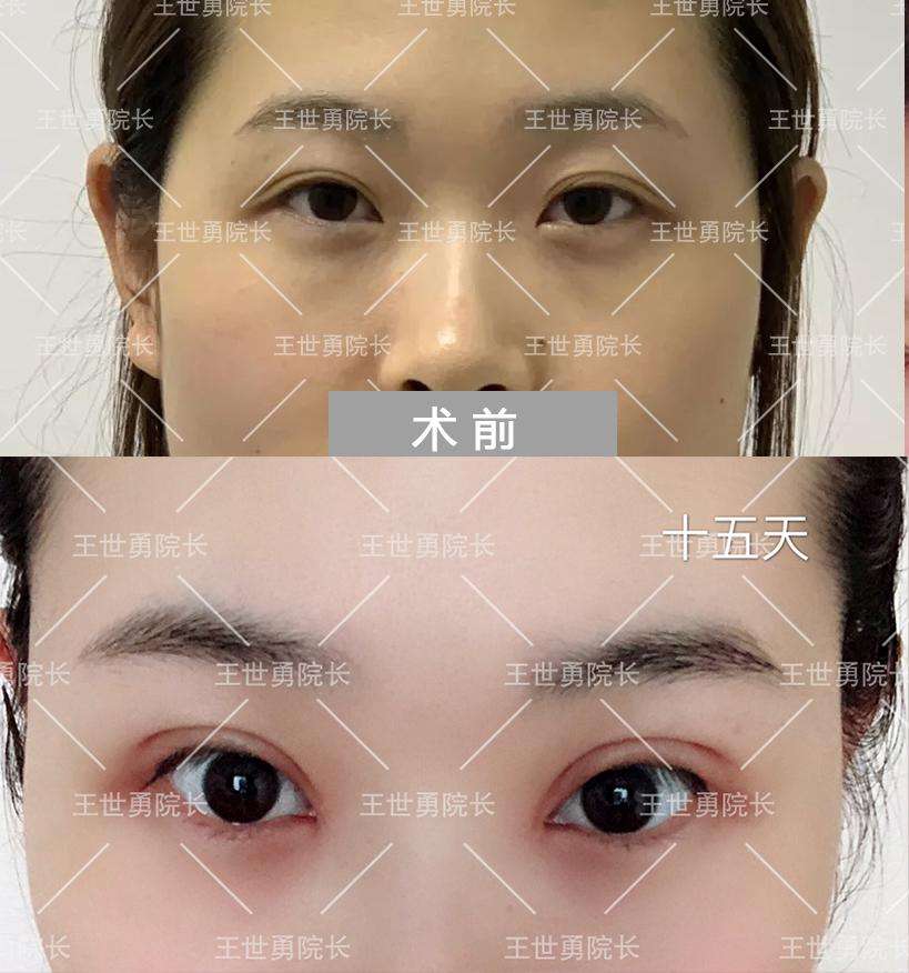 中國哪一位醫生修復雙眼皮最好?