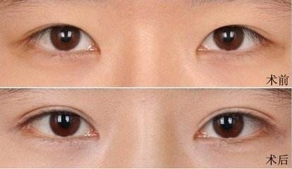 雙眼皮案例