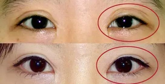 上海最好的修復雙眼皮專家排行榜