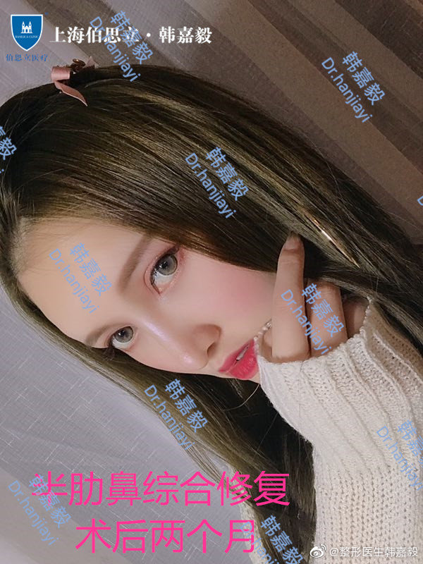 韓嘉毅鼻修復案例