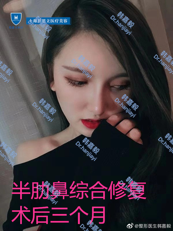 韓嘉毅鼻修復案例