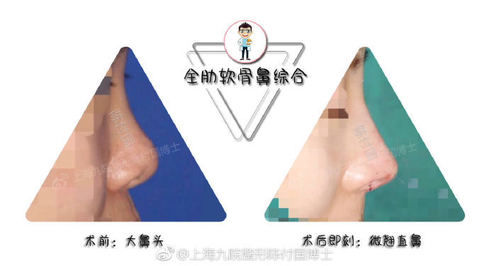 陳付國隆鼻案例