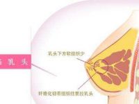 為什么要做乳頭內陷矯正?乳頭內陷有哪些危害?乳頭內陷矯正的方法有哪些?