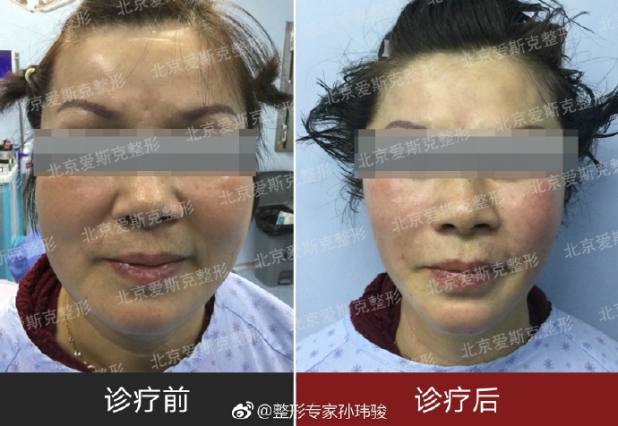 孫瑋駿面部提升案例