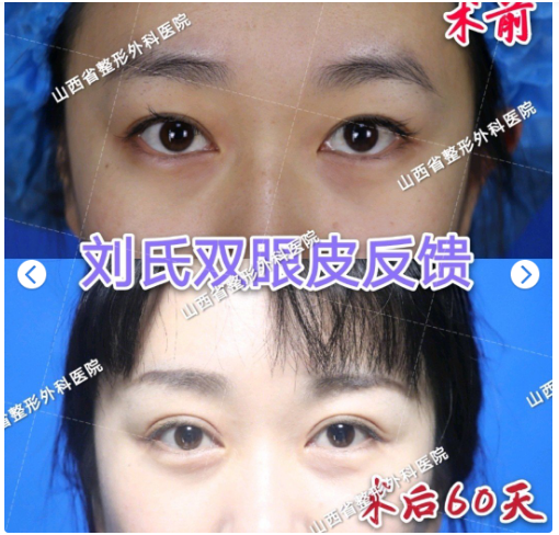 劉晉元雙眼皮案例