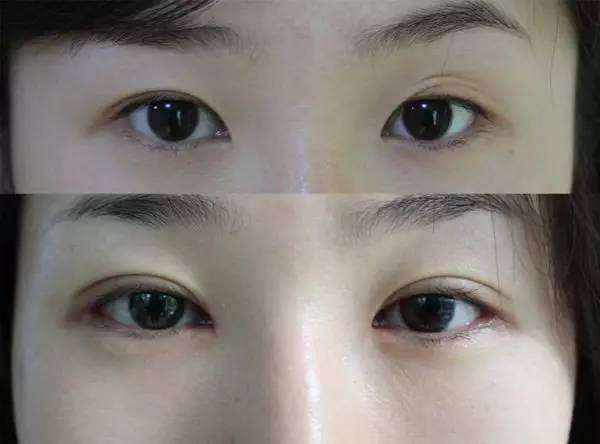 青島哪個醫(yī)生割雙眼皮和雙眼皮修復(fù)做的好？