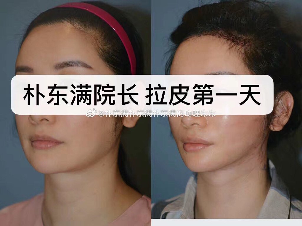 樸東滿拉皮手術(shù)