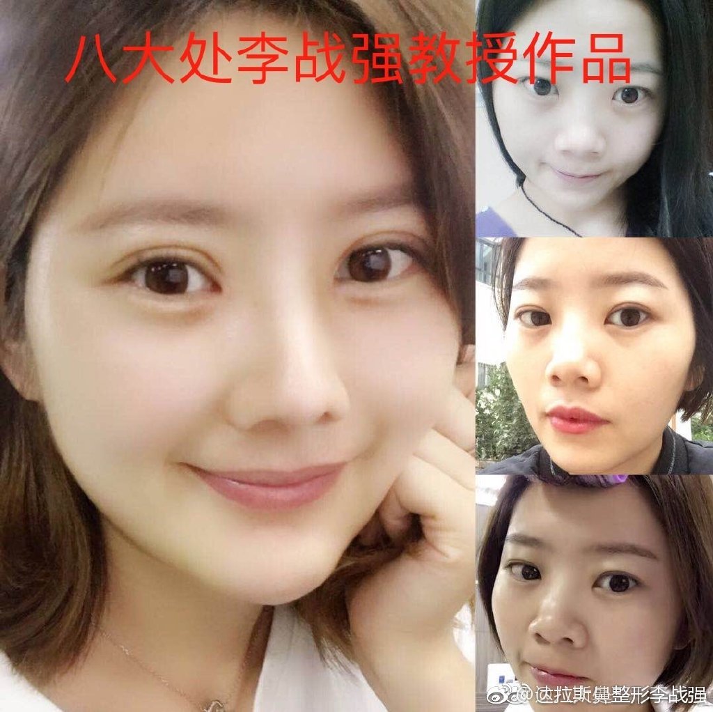 李戰強隆鼻案例