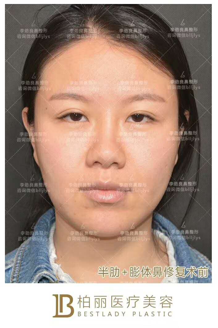 李勁良隆鼻案例