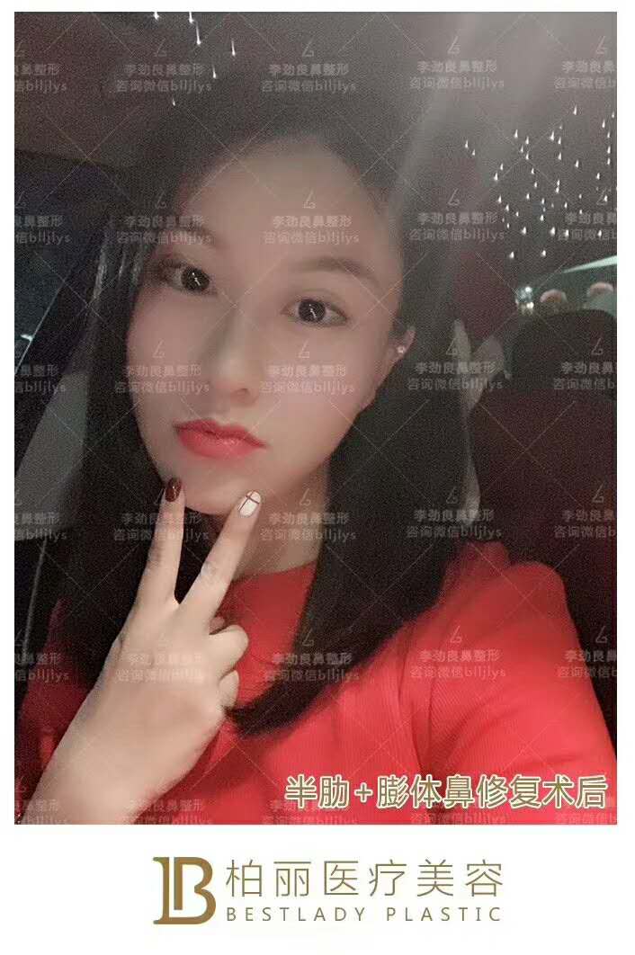 李勁良隆鼻案例后