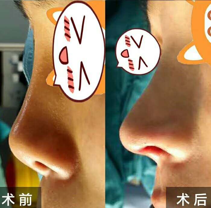 王軍隆鼻案例