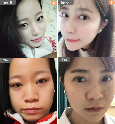 蔣思軍隆鼻案例