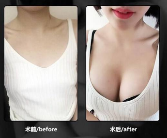 脂肪豐胸案例