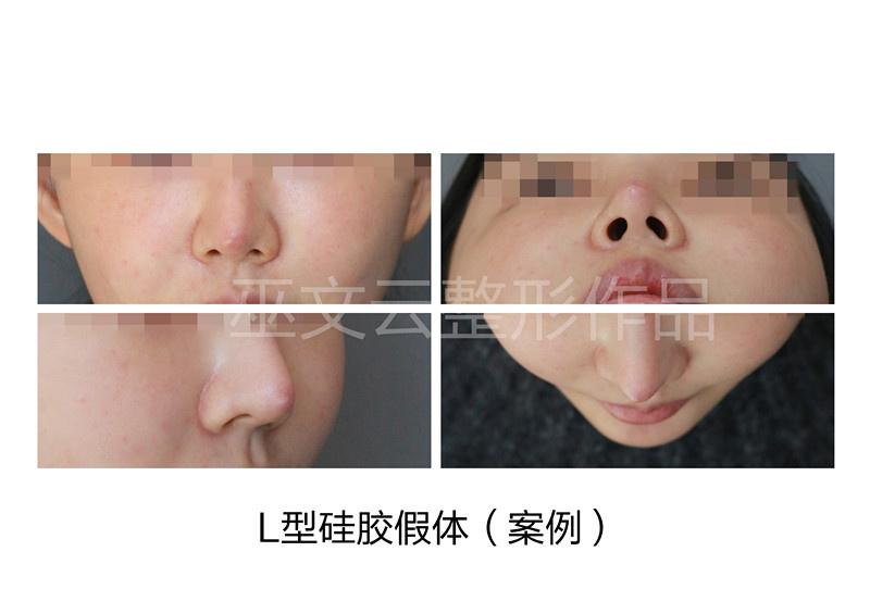 北京劉彥軍和巫文云哪個鼻子做得好？