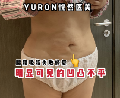 李京霖吸脂修復