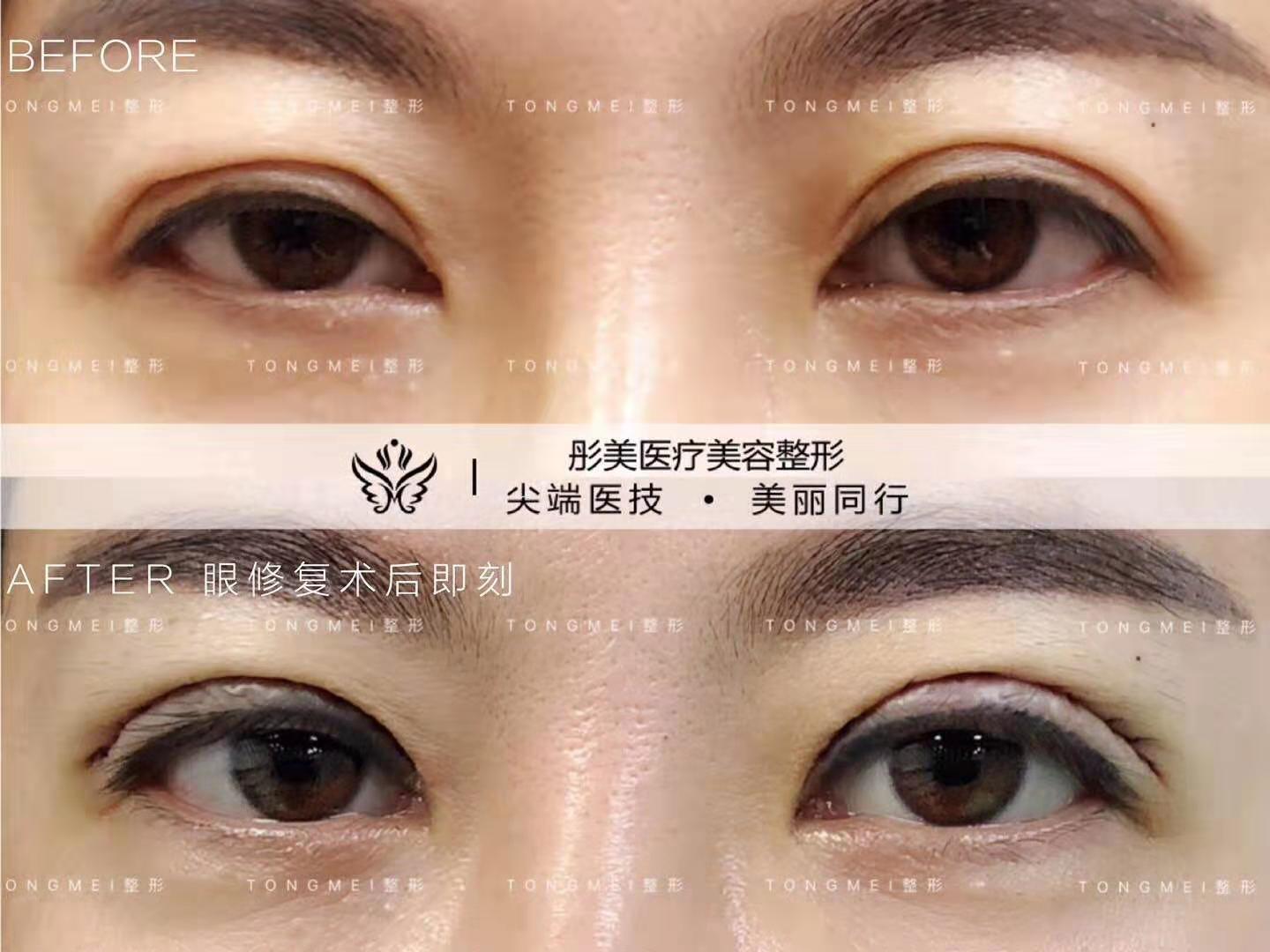 雙眼皮修復
