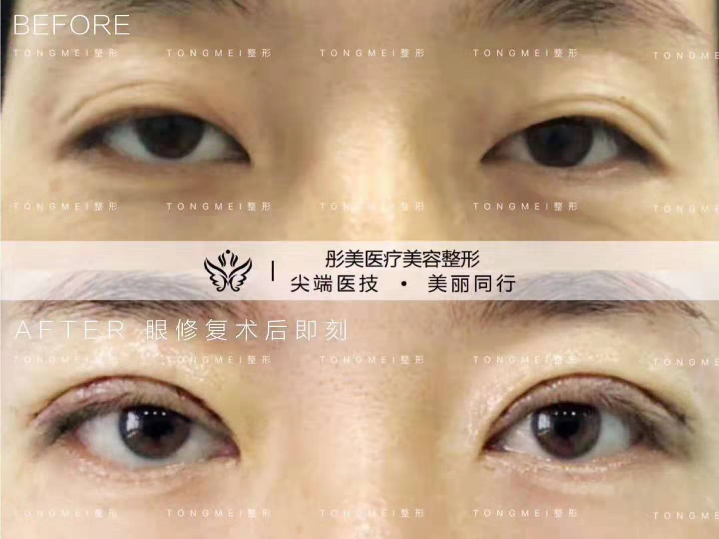 劉風卓雙眼皮修復案例