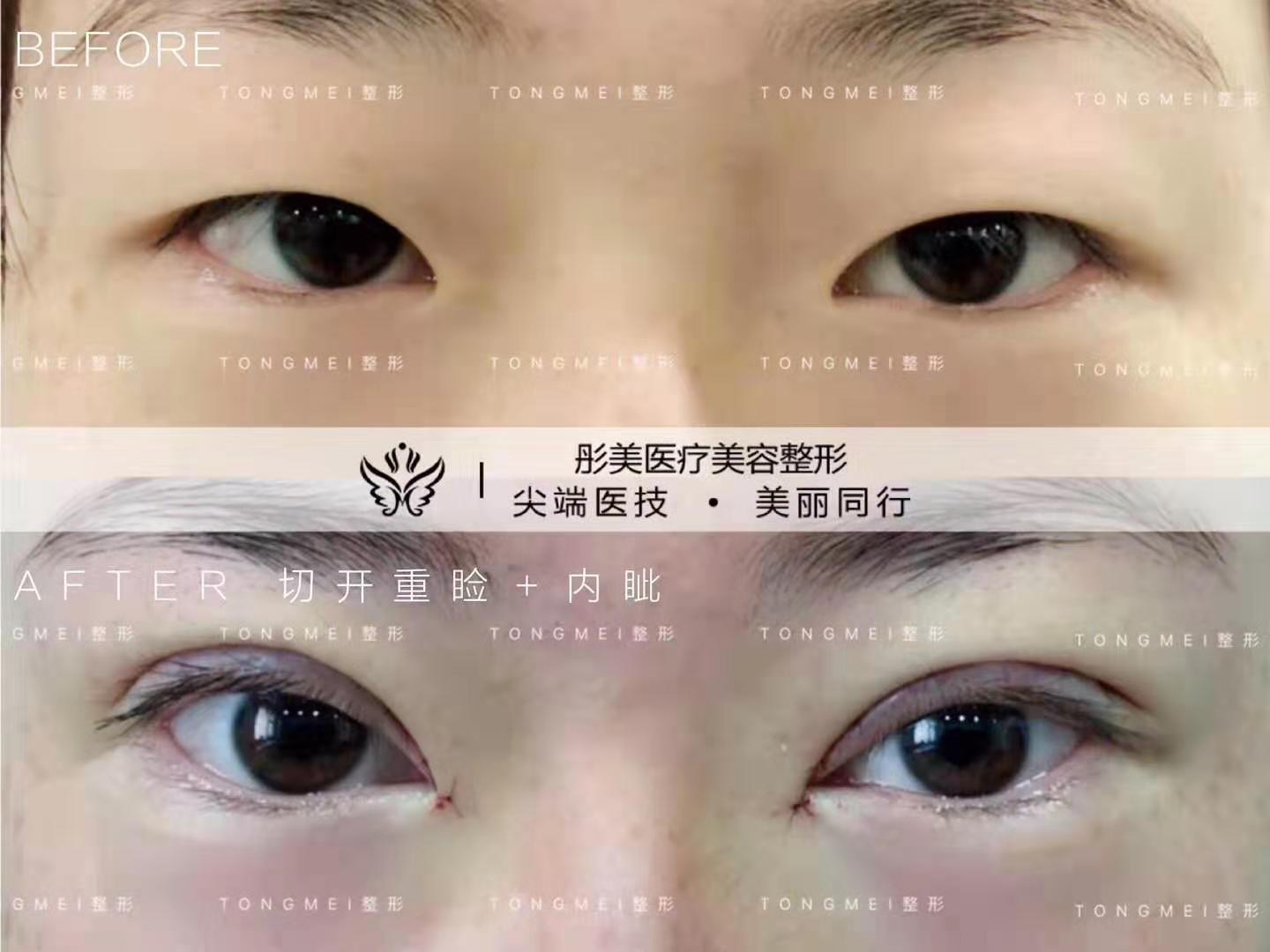 劉風卓雙眼皮案例
