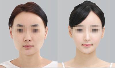 上海磨骨和下頜角哪個做的最好？李志海和何晉龍哪個好？