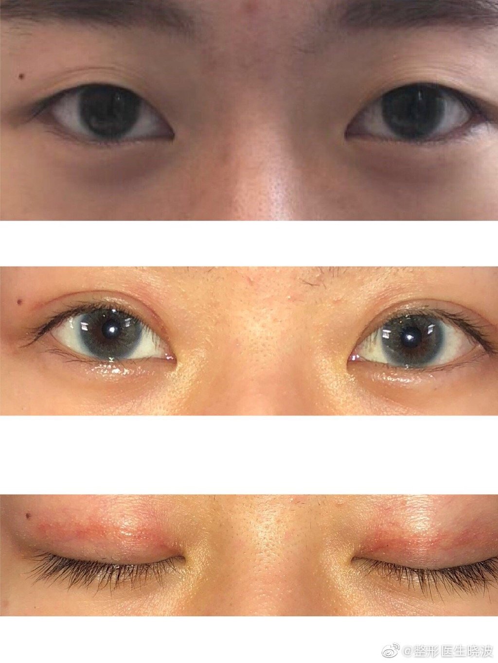 于曉波雙眼皮案例