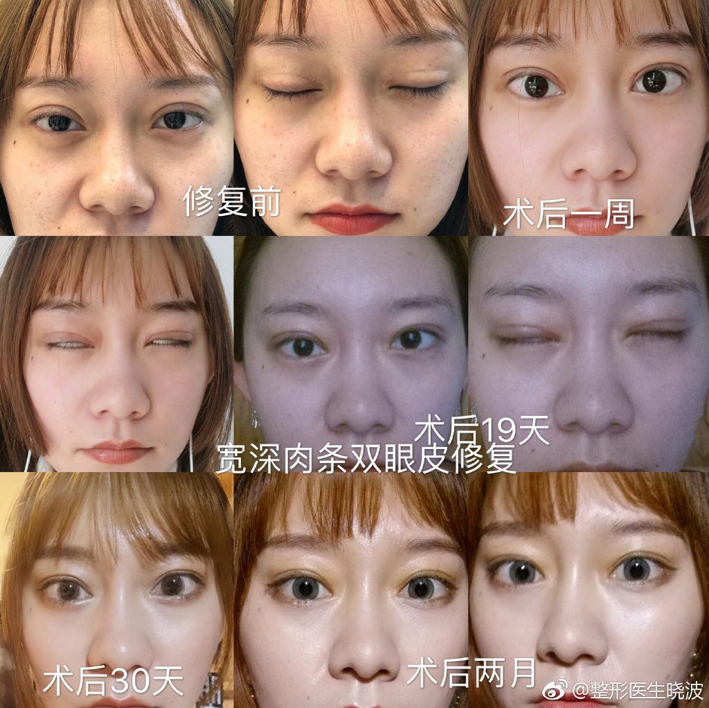 于曉波雙眼皮修復(fù)案例