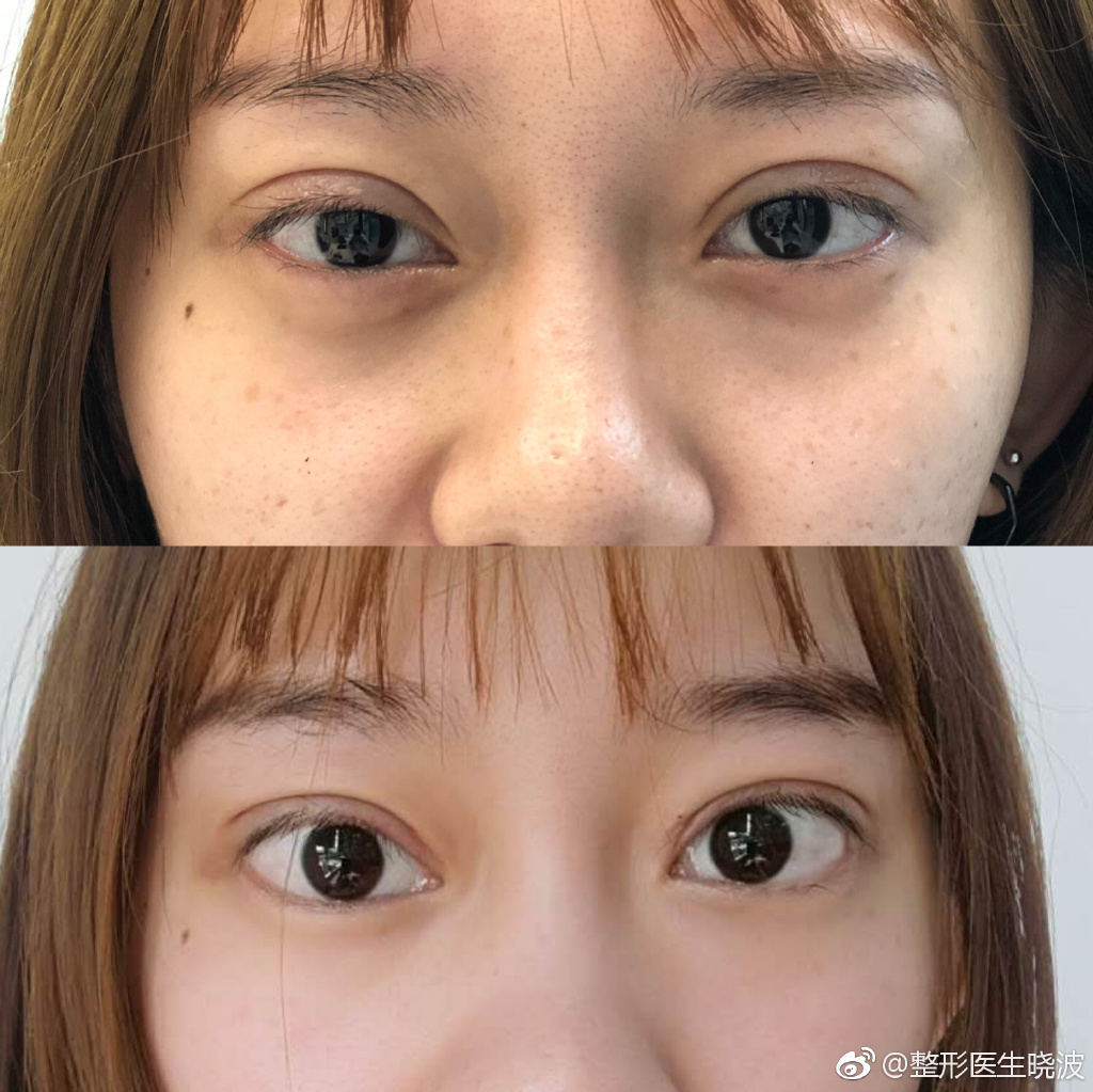 于曉波雙眼皮修復(fù)案例