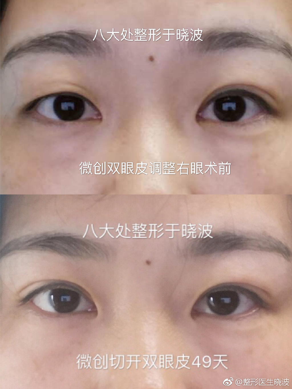于曉波雙眼皮修復(fù)案例