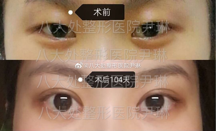 尹琳雙眼皮案例