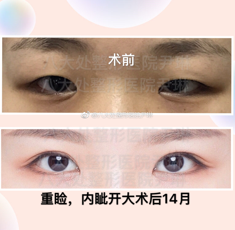 尹琳雙眼皮案例