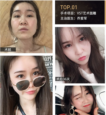 喬愛軍面部填充