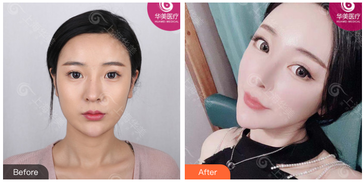 楊亞益雙眼皮案例