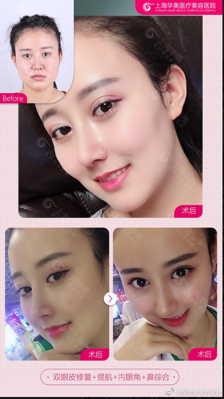 楊亞益雙眼皮案例