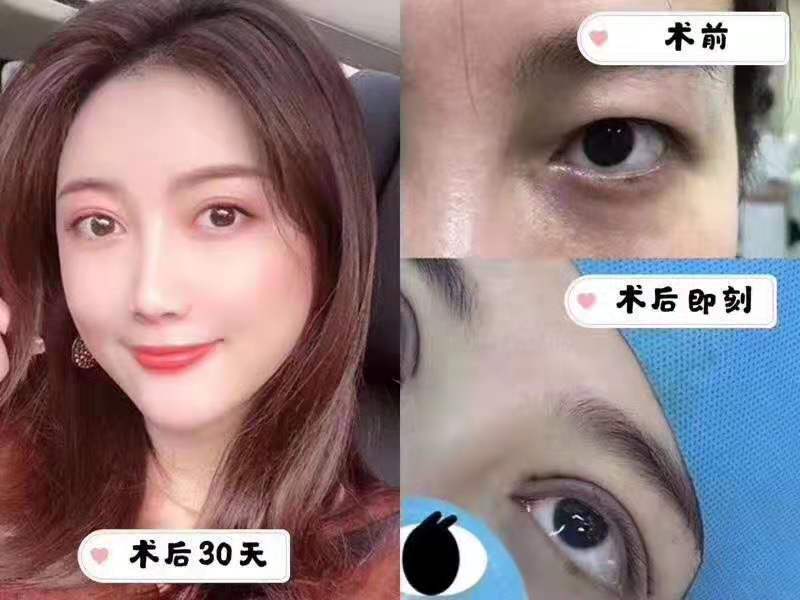鄭州割雙眼皮哪個(gè)醫(yī)生做的好？張洪波和張永濤哪個(gè)好？