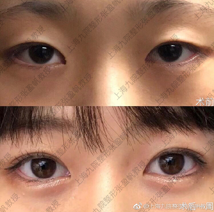 張盈帆割雙眼皮案例