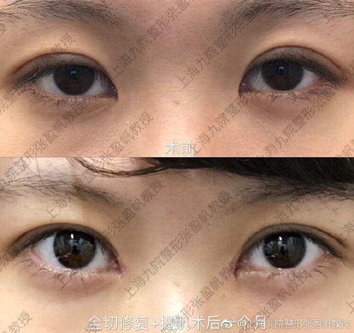 張盈帆割雙眼皮案例