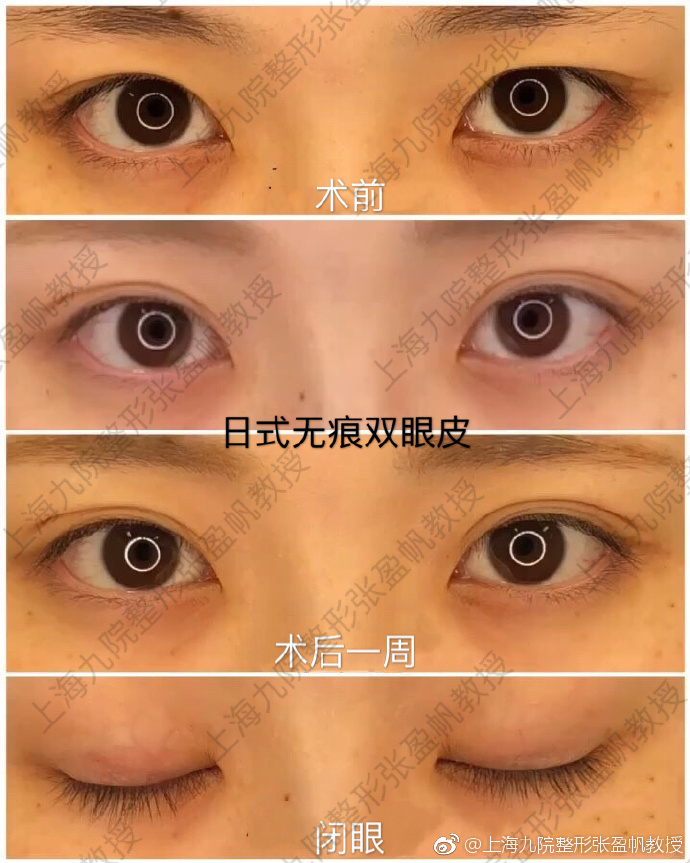 張盈帆割雙眼皮